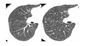 Figure 4:Επίδραση φίλτρων ανακατασκευής στην