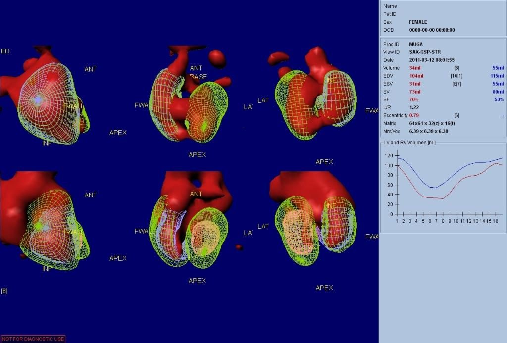 Άλλες τεχνικές απεικόνισης : MUGA Radionuclide angiography Υπολογισμός του LVEF: ακρίβεια,