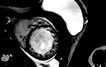 Άλλες τεχνικές απεικόνισης : MRI Περιορισμός : περιορισμένη διαθεσιμότητα Χρήσιμη : όταν υπάρχει σκέψη διακοπής της ΧΜΘ λόγω μείωσης του EF ( μετρούμενο με