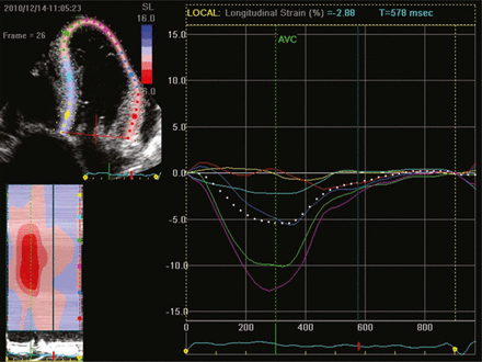 Πρώϊμη ανίχνευση LV δυσλειτουργίας με Strain και Strain Rate Global longitudinal strain είναι η καλύτερη παράμετρος για την πρώιμη ανίχνευση της υποκλινικής δυσλειτουργίας της LV (normal values range