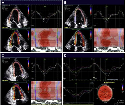 Speckle-tracking Echo: GLS Ασθενής με καρκίνο μαστού με Κ/Τ μετά από θεραπεία