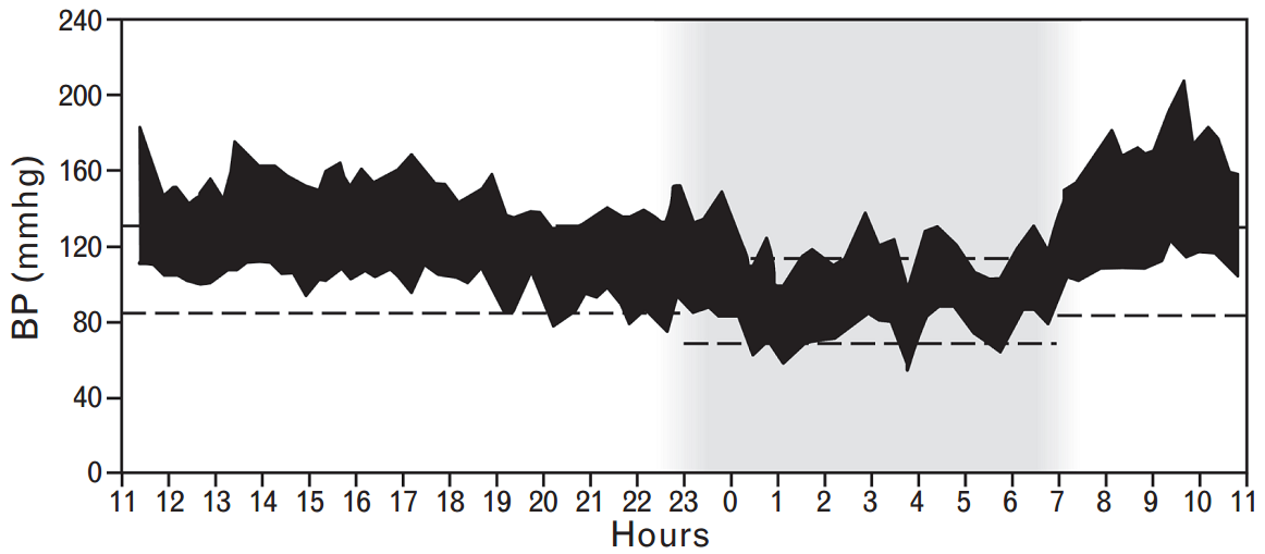 Συγκαλυμμένη υπέρταση Clinic BP at 138/88 mmhg Increased daytime BP particularly during working