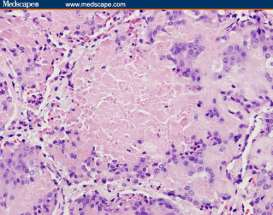 ΑΕΔ (ΜΙΑ) Arch Pathol Lab Med. 2012;136:1194 1197; doi: 10.