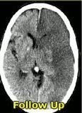 CT - MR Perfusion (CTP) Eκτίμηση ισχαιμικής περιοχής (penumbra - tissue at risk) Μέτρηση χρόνου και ποσότητας διέλευσης