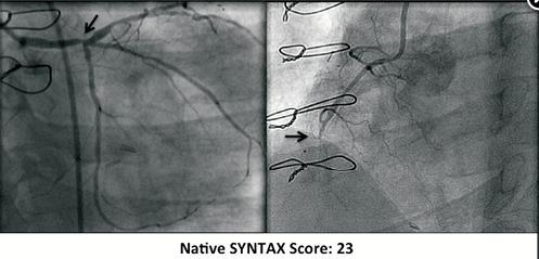 CABG SYNTAX Score To CABG SΥΝΤΑX score είναι ουσιαστικά το SΥΝΤΑX score των γηγενών αγγείων, μετά την αφαίρεση των βαθμών από τα τμήματα