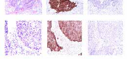 HPV strategies to avoid immune recognition: suppression Repression of TLR9 (signal pathways) by E6/E7 Normal x4 Normal x40 Patient a HPV16 x20 Patient b HPV16 x20 pan