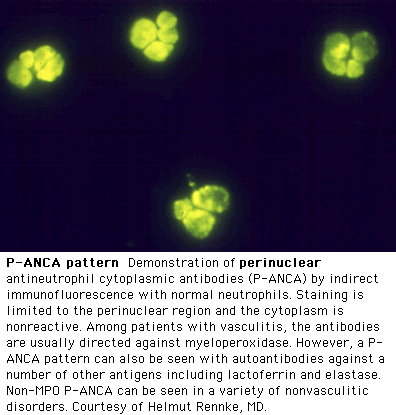 ΑNCA Μέθοδοι ανίχνευσης: Έμμεσος ανοσοφθορισμός Ανοσοενζυμική μέθοδος Κοκκιωμάτωση Wegener P-ANCA: Μυελοϋπεροξειδάση (MPO) Περιπυρηνικός