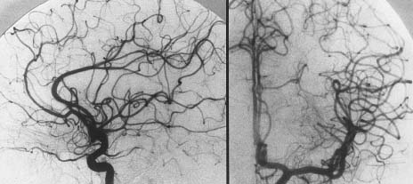 Cranial Malignant (gliomas, brain metastases) Benign (acoustic neurinomas, pituitary adenomas, arteriovenous malformations, trigeminal neuralgia,