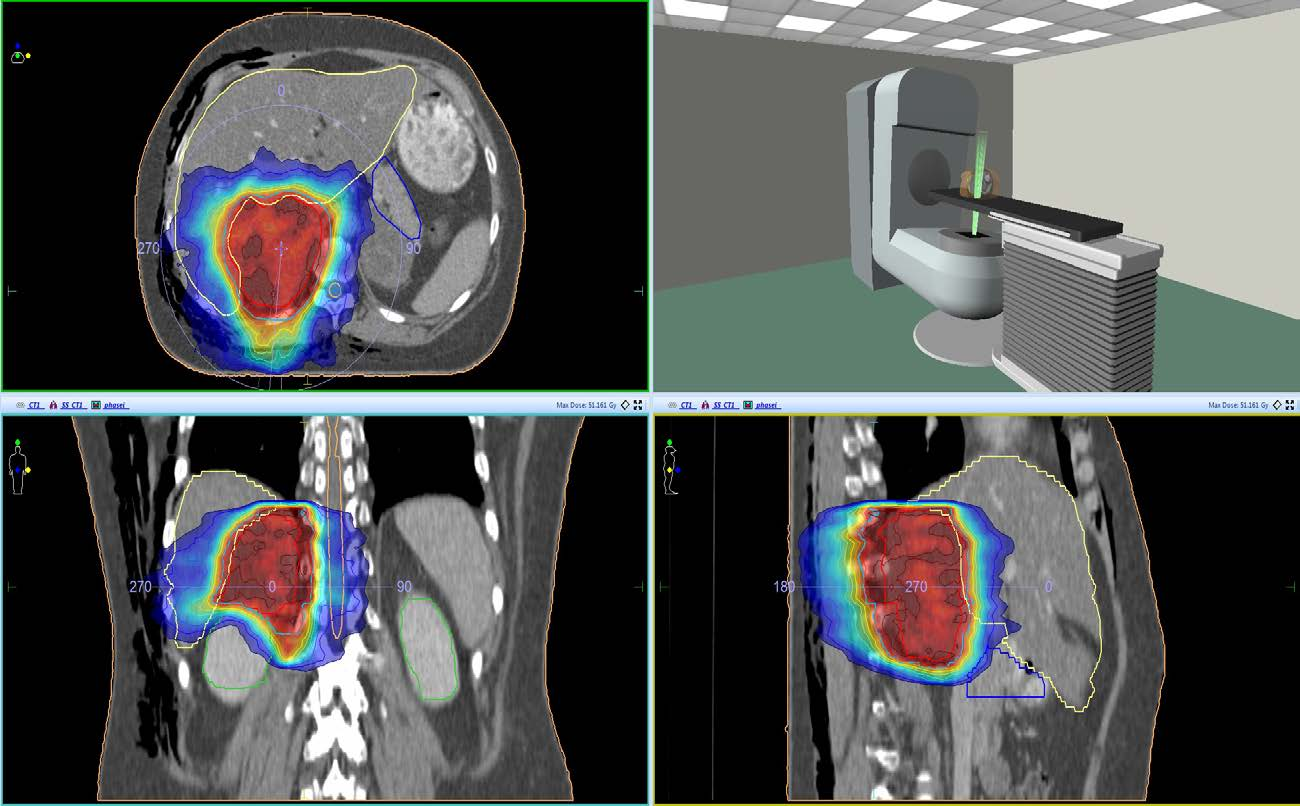 Adrenal metastasis 12Gy