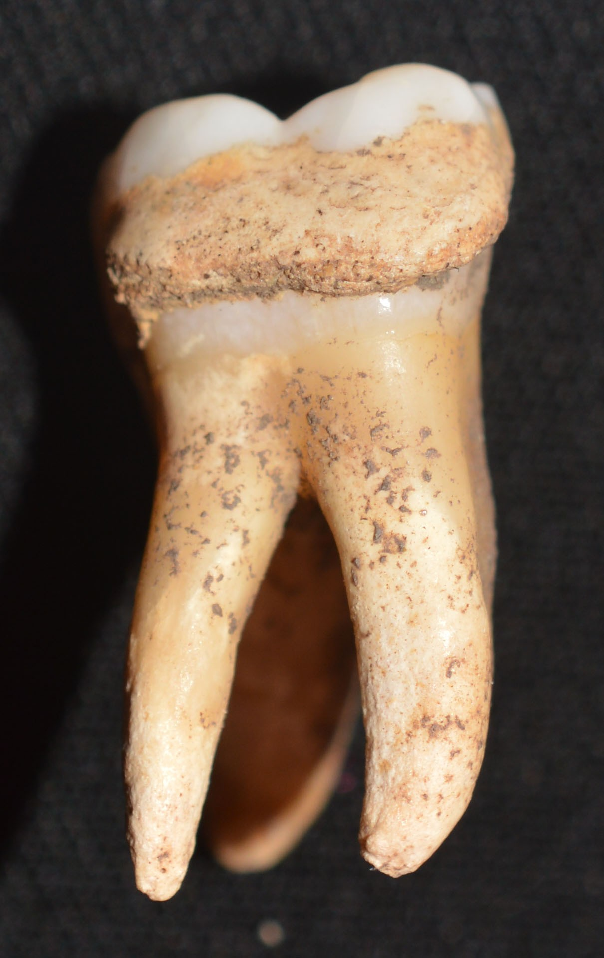 Τερηδόνα σε γομφίο της κάτω γνάθου: γνάθου χαρακτηρίζεται από τη μη αναστρέψιμη και σταδιακή χημική αποσύνθεση των οδοντικών ιστών από οξέα που εκλύονται από τη βακτηριακή ζύμωση υδατανθράκων Το