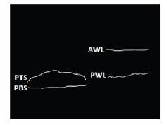 38 η κάτω επιφάνεια της αθηρωματικής πλάκας (PBS Plaque Bottom Surface) το άνω όριο του αρτηριακού τοιχώματος με τον αυλό (AWL Anterior Wall Lumen) το κάτω όριο του αρτηριακού τοιχώματος με τον αυλό