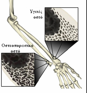 Επομένως, η οστεοπόρωση είναι, σύμφωνα με τις σημερινές απόψεις, όχι απλά μία ποσοτική διαταραχή του οστού αλλά και ποιοτική μεταβολή, που είναι δυνατόν να εκτιμηθεί με απευθείας μετρήσεις των