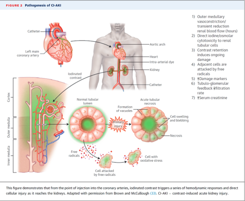 Νεφροπάθεια από σκιαγραφικό 1)Outer medullary vasoconstriction/ transient reduction renal blood flow (hours) 2) Direct iodine/osmolar cytotoxicity to renal tubular cells 3) Contrast retention