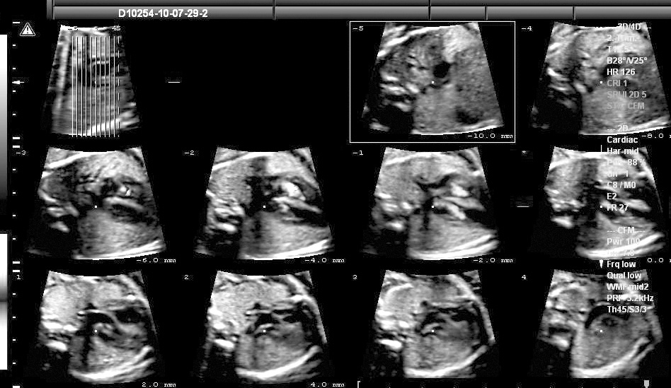 Tρισδιάστατη (3D) υπερηχοκαρδιογραφία στο έμβρυο Γερμανάκης Ι.