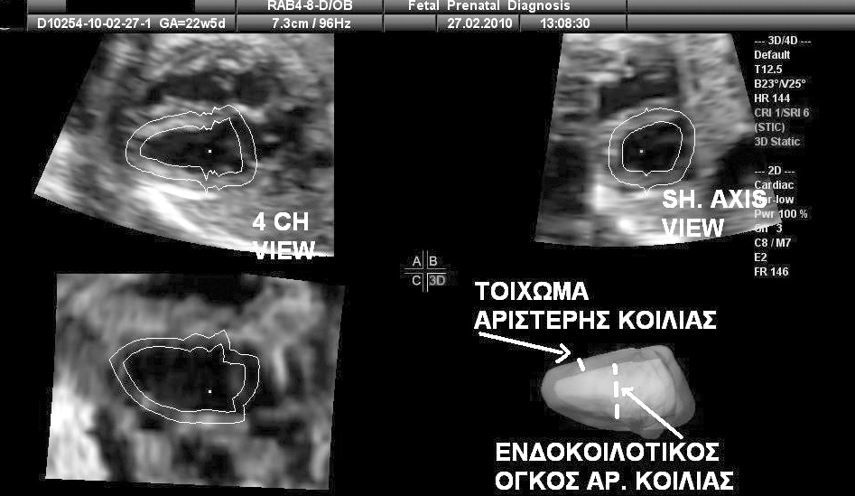 3D εμβρυϊκή υπερηχοκαρδιογραφία: τεχνικές 1).