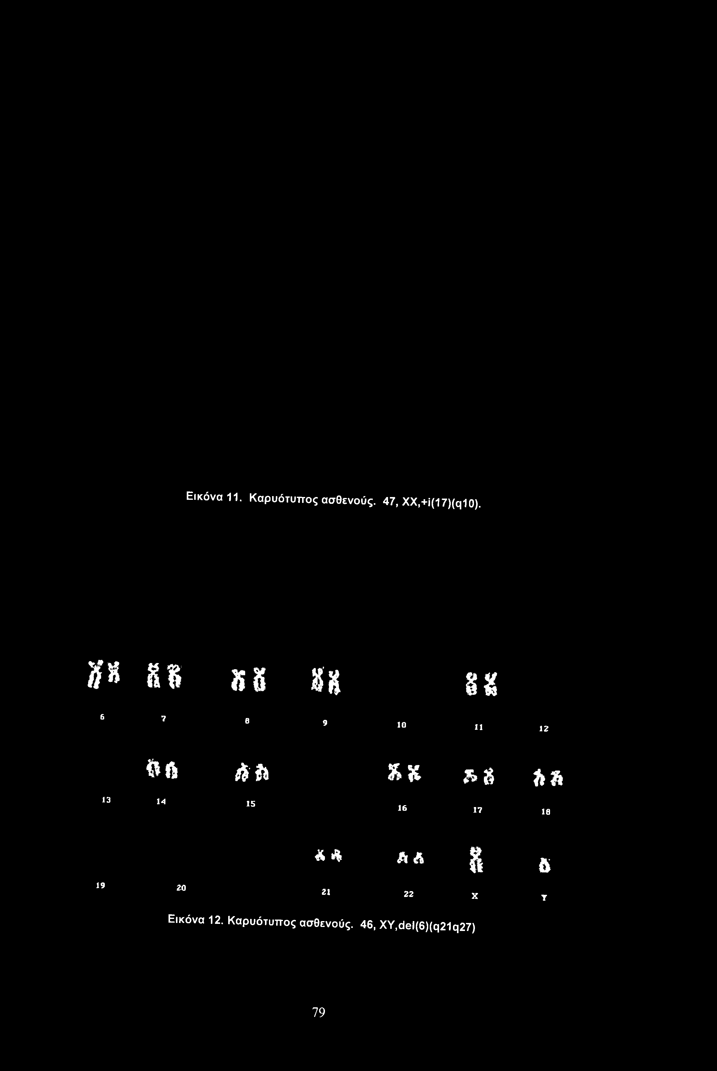 Εικόνα 11. Καρυότυπος ασθενούς. 47, XX,+i(17)(q10).