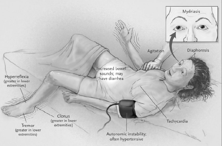 Midrijaza agitacija dijaforeza Hiperrefleksija (veća u nogama) Zvukovi u crevima, sa mogućom dijarejom Tremor (veći u nogama) Klonus (veći u nogama) Autonomna nestabilnost, često hipertenzija