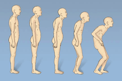 Κοιλιακή προβολή: Με την µείωση του ύψους του ηβικού οστού επέρχεται προβολή της κοιλιάς και το δέρµα παρουσιάζει πτυχές.