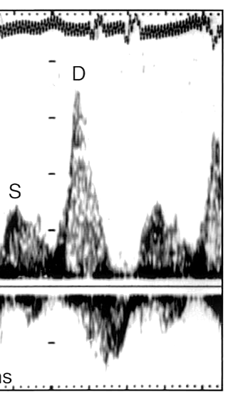 Pulmonary Venous velocities S D D S When S-wave is < 40 % of D-wave