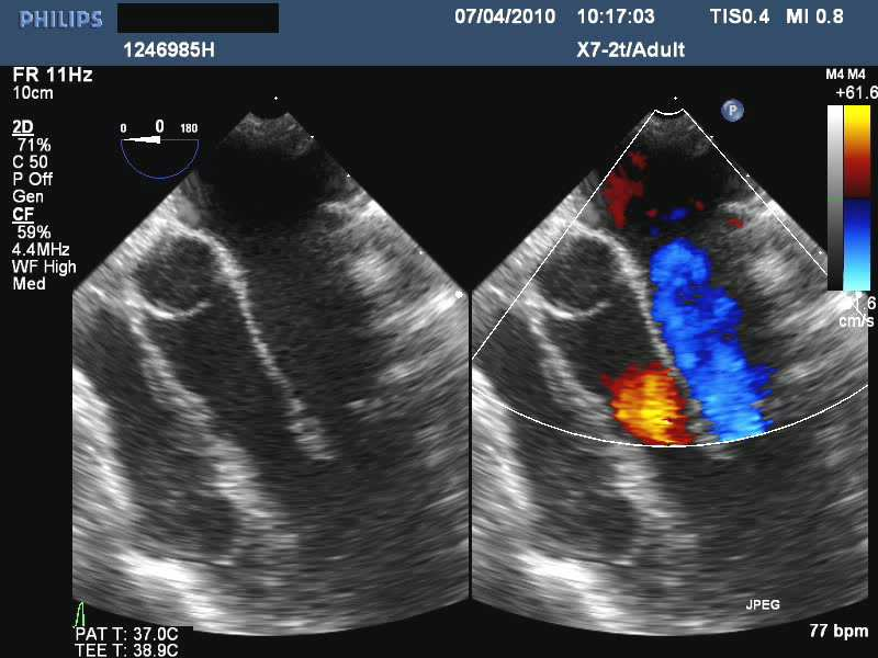 Echo mitral