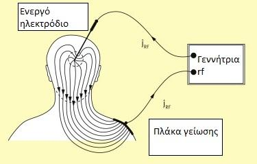 Σε έρευνα που πραγματοποιήθκε από τους MacVicar et al (2007) σε ένα σύνολο 104 ασθενών με χρόνια κεφαλαλγία εξετάστηκε η αποτελεσματικότητα της νευρότμησης με ραδιοσυχνότητες.