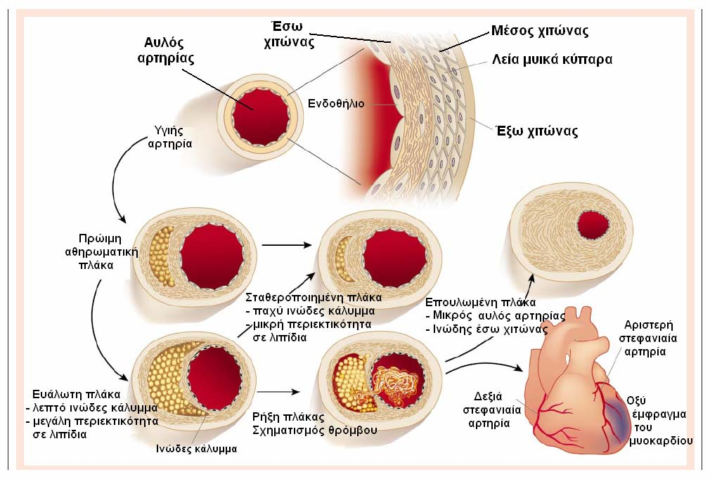 τοιχώματος συγκεκριμένα λόγω του σχηματισμού αθηρωματικών πλακών, ενώ η δεύτερη αφορά τη σκλήρυνση του αρτηριακού τοιχώματος για οποιονδήποτε λόγο (συμπεριλαμβανομένου του σχηματισμού αθηρωματικών
