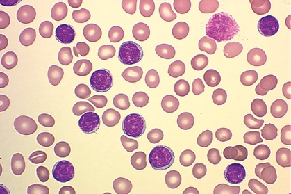 B- cell CLL/SLL Peripheral blood smear (Wright-Giemsa stain, x 100). Ronald M.