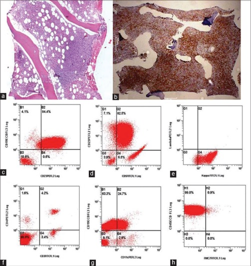 cells) Ø CD5+, CD23+, CD19+ Ø λ ελαφριές αλυσίδες+ και κ- Dewan K, Mann N, Chaxerjee T.