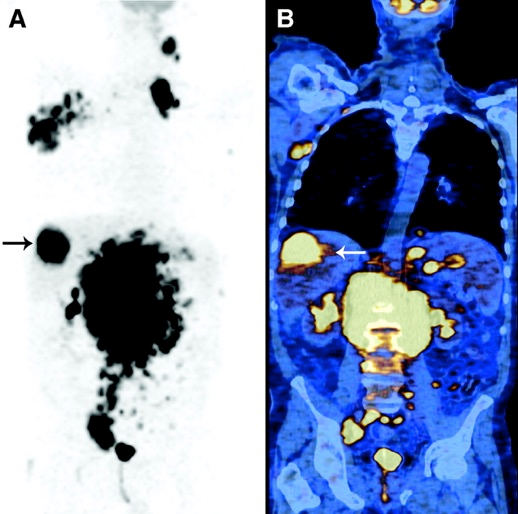 70-y-old man with 1-y history of CLL, who had completed chemotherapy. John F.