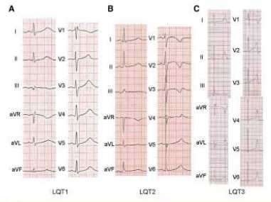 ECG in