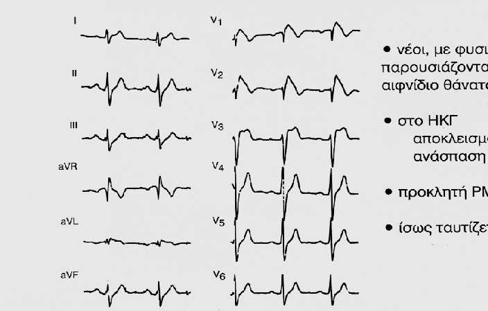 Brugada Syndrome (BrS) The diagnosis of BrS requires the signature type 1 Brugada ECG pattern.