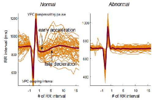 HRT classification 1. HRT 0 (T.O. 0%, T.S. > 2.5 msec/rr) 2.