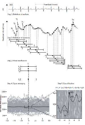 Deceleration capacity computation of heartbeat intervals longer than the preceding interval Step 1. Definition of anchors Step 2.