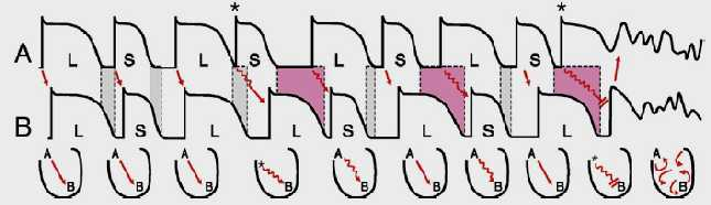 T-wave alternans a beat-to-beat fluctuation