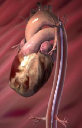 coronary perfusion - increases