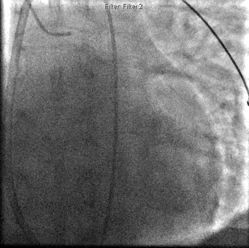 IABP + ECMO 27 ετών καπνιστής με οικογενή υπερχοληστερολαιμία,