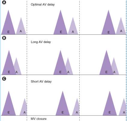 Non responders to CRT - echo driven AV, VV delay optimization AV delay Συμβάλλει στη βέλτιστη πλήρωση της αρ.