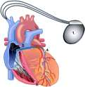 Καρδιακή ανεπάρκεια Καρδιακός επανασυγχρονισμός Η καρδιακή ανεπάρκεια είναι μια ετερογενής νοσολογική οντότητα είναι και η ίδια η νόσος εκτός από τη μέθοδο μελέτης που καθορίζει το αποτέλεσμα CRT.