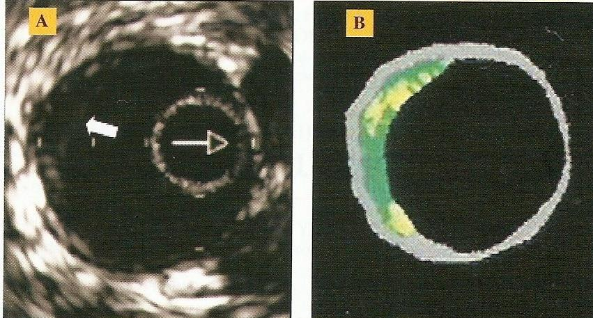 FUNCTIONAL MODIFICATIONS of RADIAL after CATHETERIZATION Reduction of