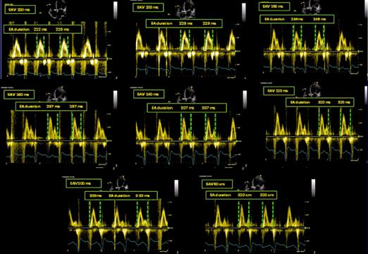 AV Delay Echo Optimization: Iterative Method SAV 220ms SAV 200ms SAV 180ms The optimal AV delay is considered: The minimal AV delay that allows adequate E and A wave