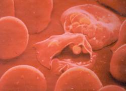 DNA-diagnostika: malarija Diagnosticiranje malarije Malarijo povzroča parazit Plasmodium falciparum, ki inficira in razgradi eritrocite.