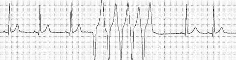 NSVT in patients with Ischemic Cardiomyopathy (MADIT I): The ultimate tool for risk stratification in primary prevention 54% reduction in mortality rate 196 pts with previous ( 3 weeks before entry)