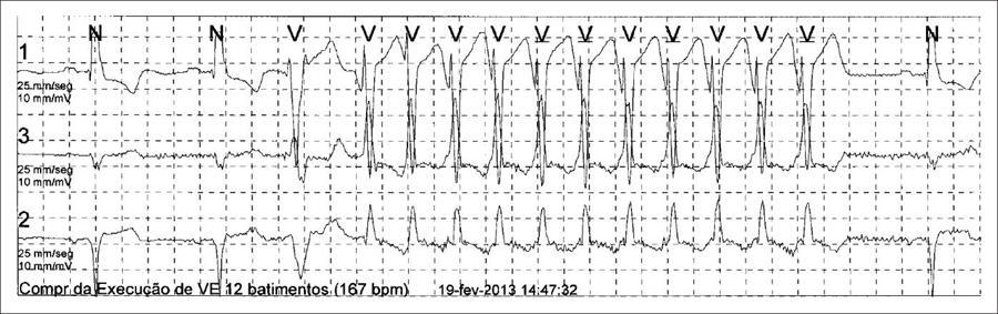 Nonsustained Ventricular Tachycardia (NSVT) Definition: NSVT is defined as 3 (sometimes 5) or more consecutive