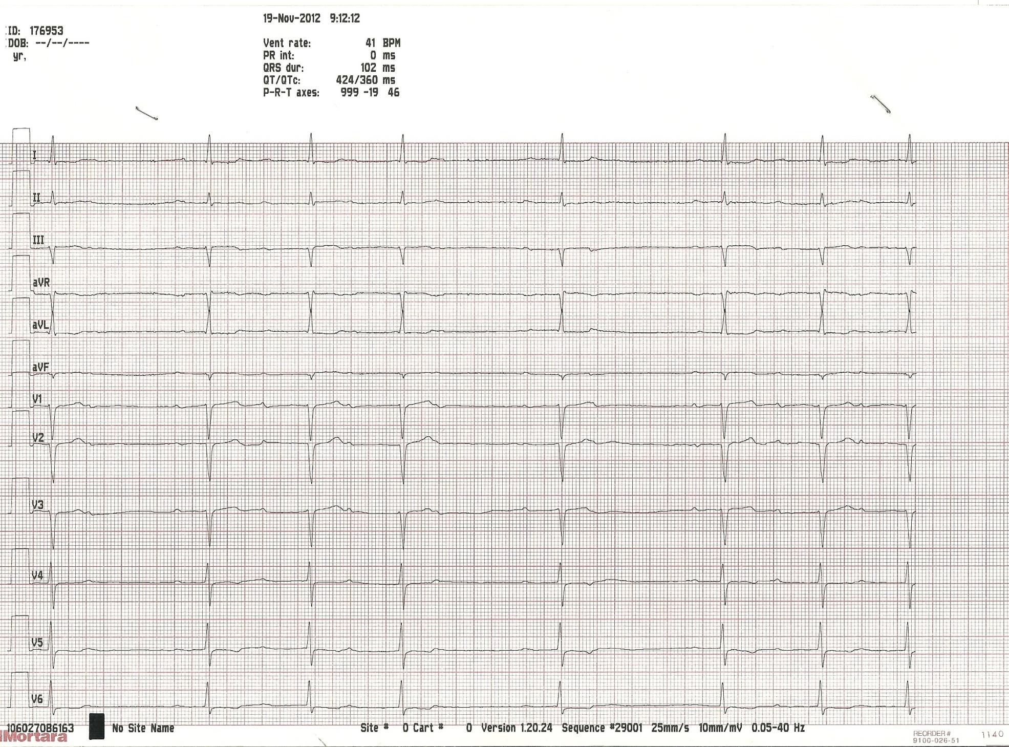 53 year-old man Symptomatic 2 nd degree AV block LVEF:55% (no