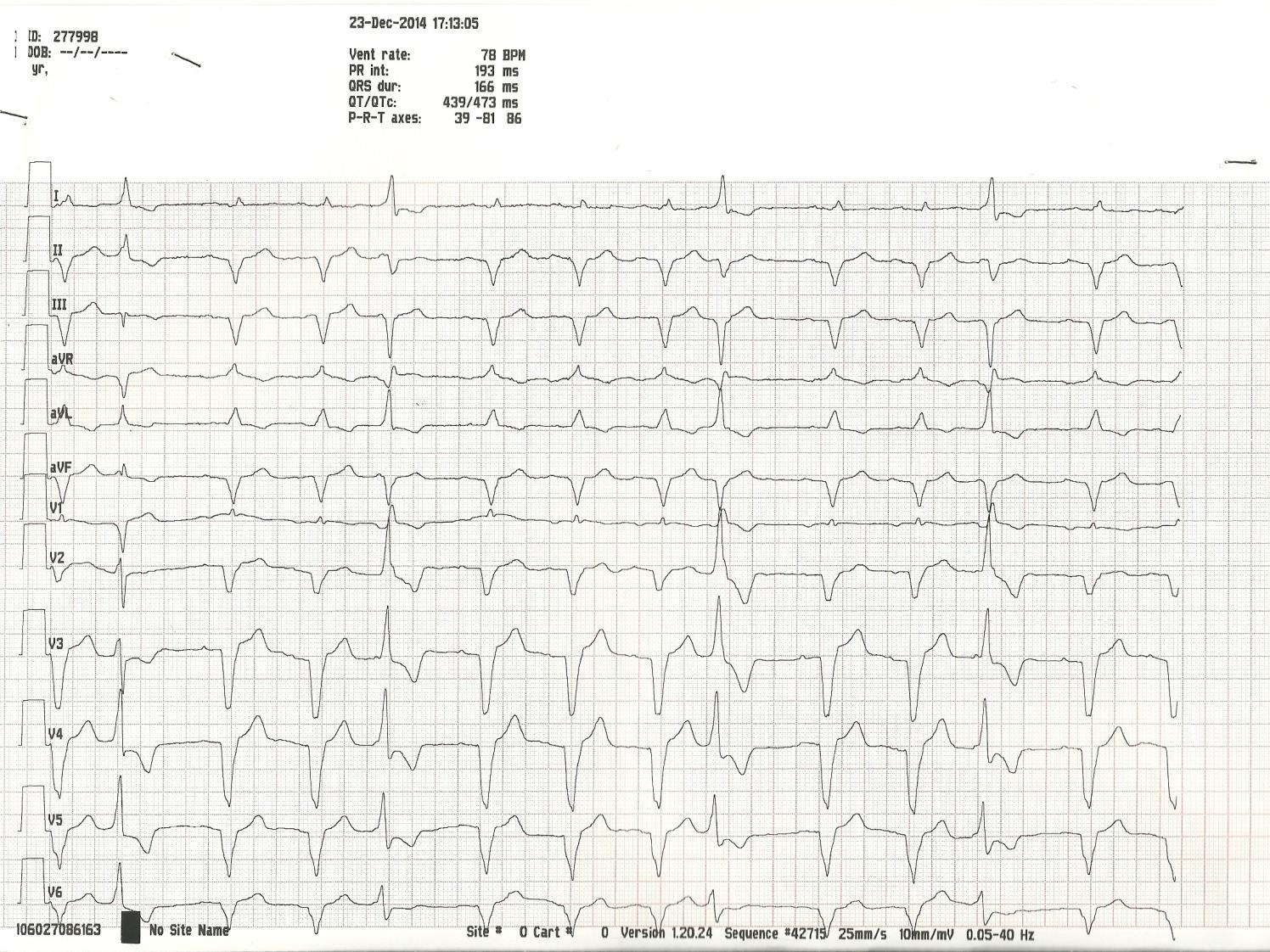 NSVT in routine PM interrogation Coro: (-) 3 years