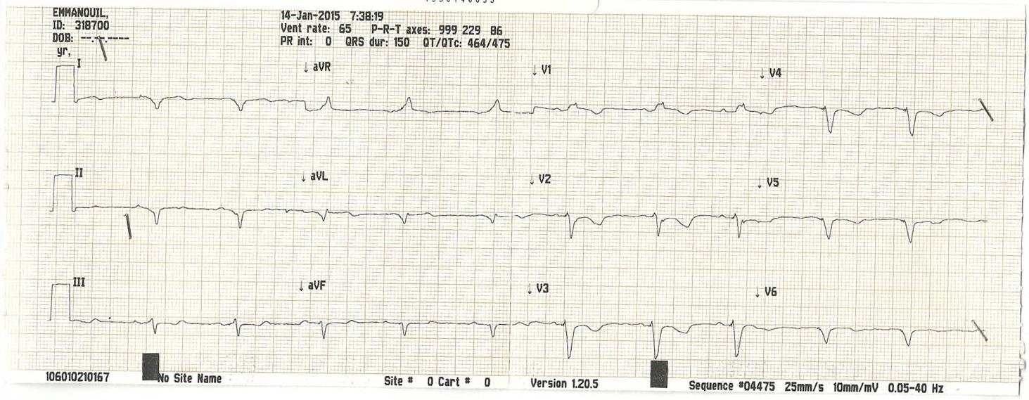 CRT-D implantation