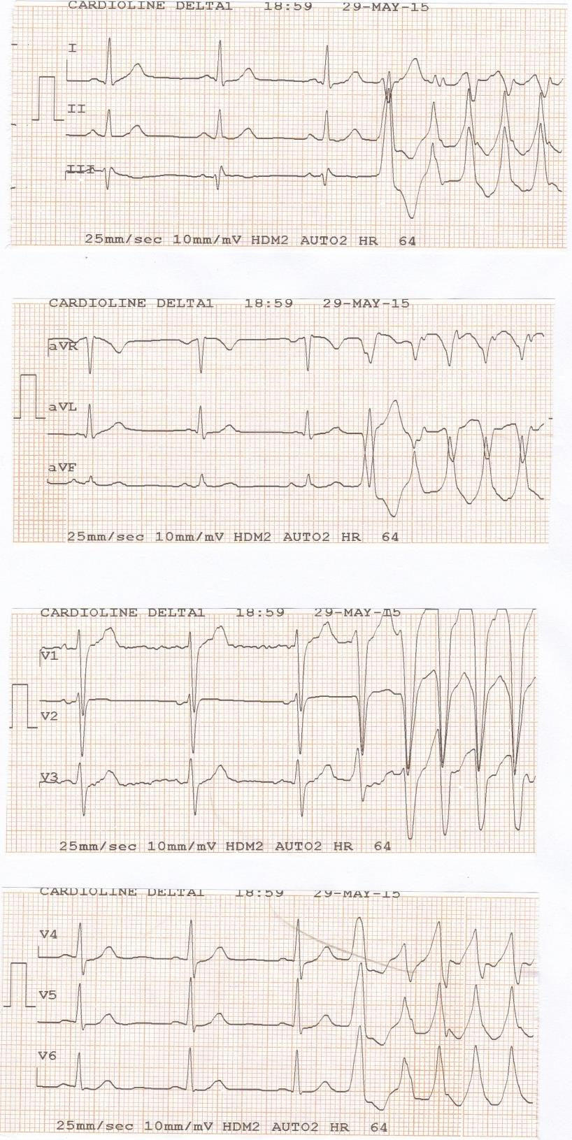 Idiopathic NSVT 47 years-old man Palpitations No structural Heart Disease