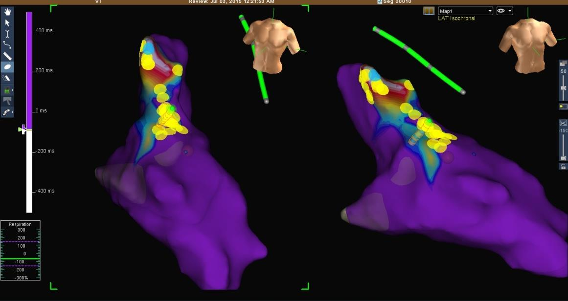 Catheter Ablation Activation, Pace and 3D Mapping Low voltage areas 24h Holter: Elimination of