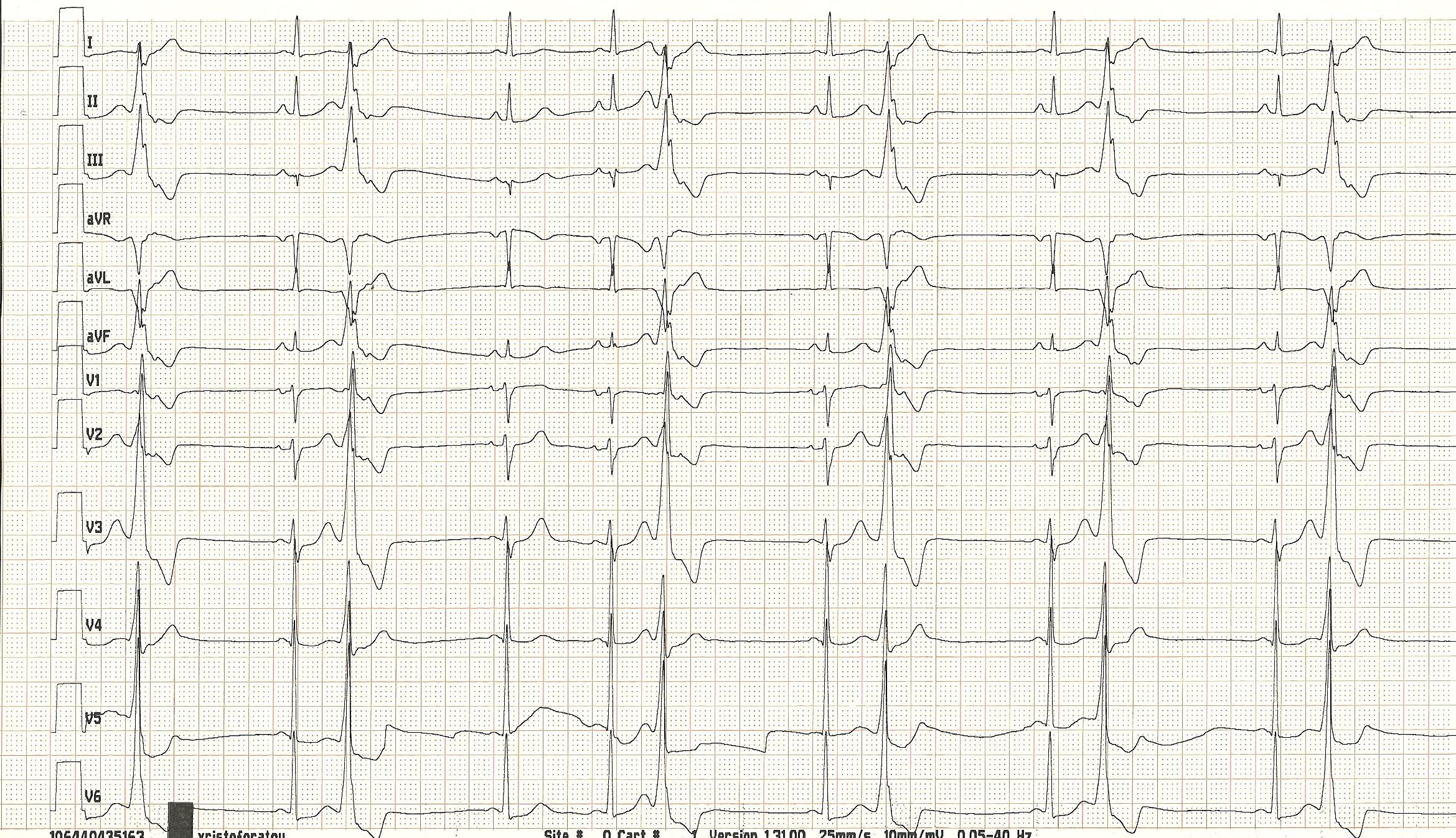 Cardiomyopathy from High