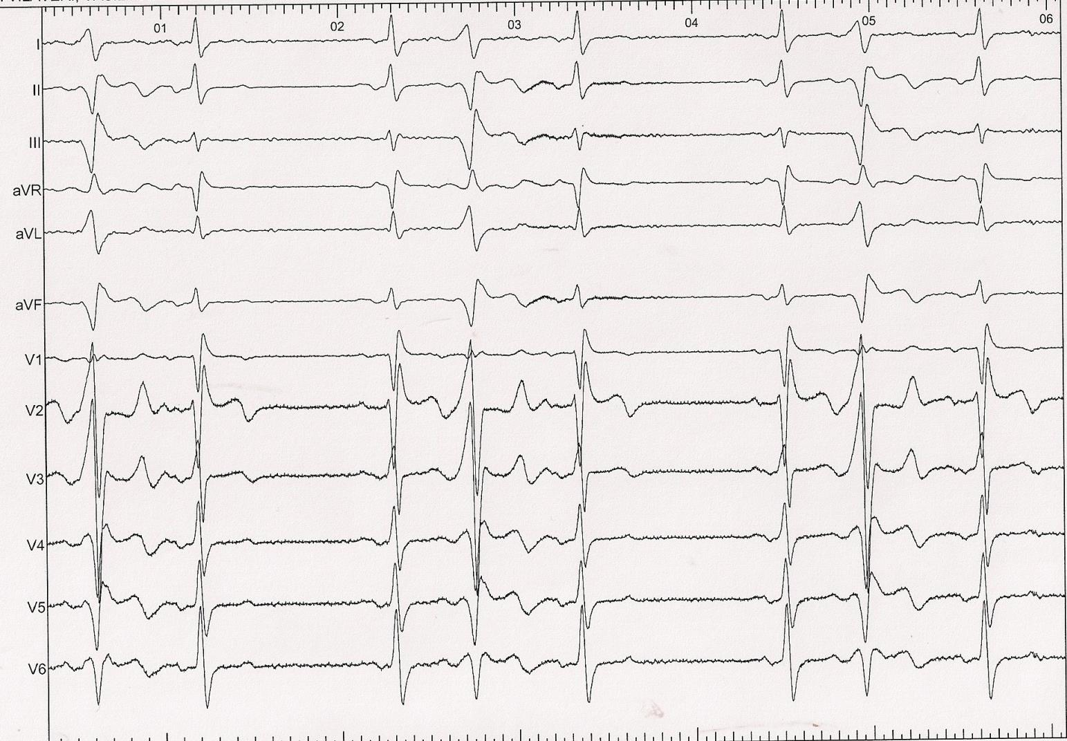 55 year old woman Palpitations, Shortness of breath